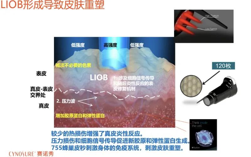 做完蜂巢皮秒饮食注意,做完蜂巢皮秒后起泡了怎么护理