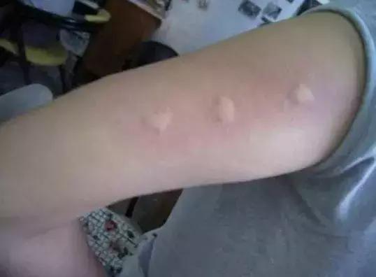 孕妇被蚊子咬了怎么止痒消肿,蚊子咬了止痒消肿最快的办法