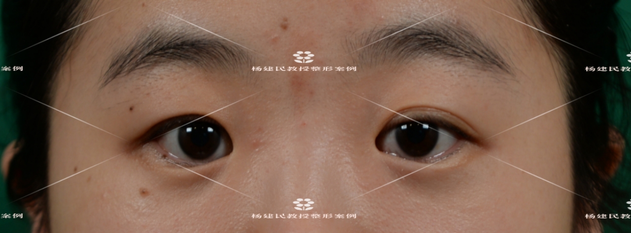 眼睑内翻倒睫治疗方法,老年人倒睫最快的治疗方法