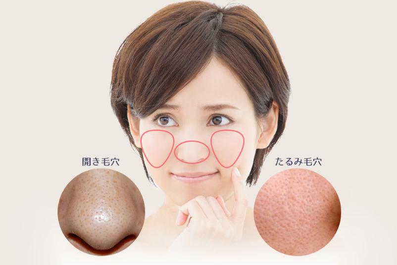 夏天毛孔粗大浮粉小技巧,改善毛孔粗大的方法测评