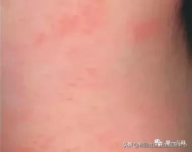 手足口病及水痘等传染病防控知识,手足口病和幼儿急疹和水痘的区别