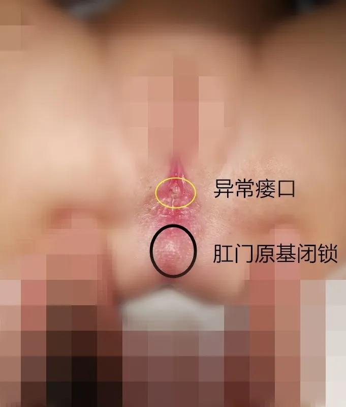 女婴出生没有双腿被狠心父母抛弃,宝宝出生半年才发现无肛