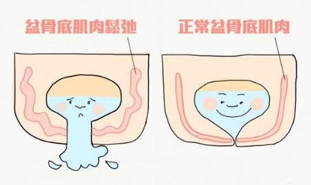 难以启齿，她每次排便需要把手伸入阴道，医生说这是病得治