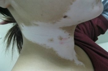 7岁女童头部白癜风长大了会好吗,白癜风能治好吗七岁女童