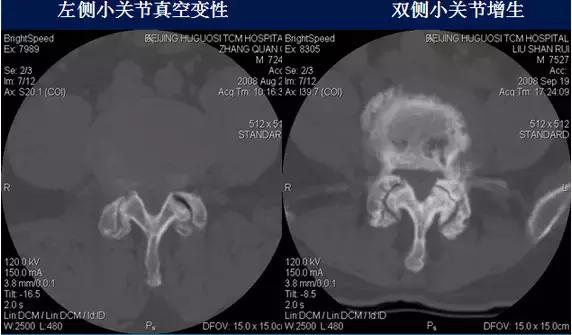 腰椎退行性变腰椎间盘轻度突出,椎间盘突出并膨出继发椎管狭窄
