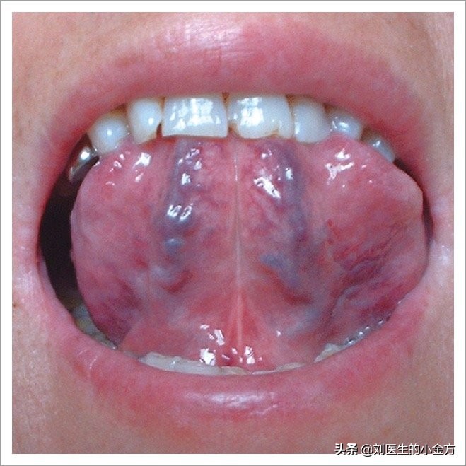 中医舌诊对照表100例,舌诊辨九大体质