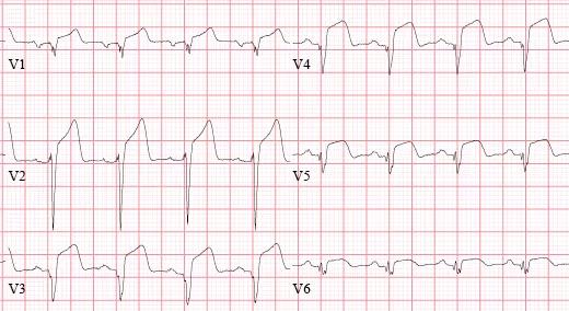 常见心梗特殊心电图,各部位心梗心电图详解