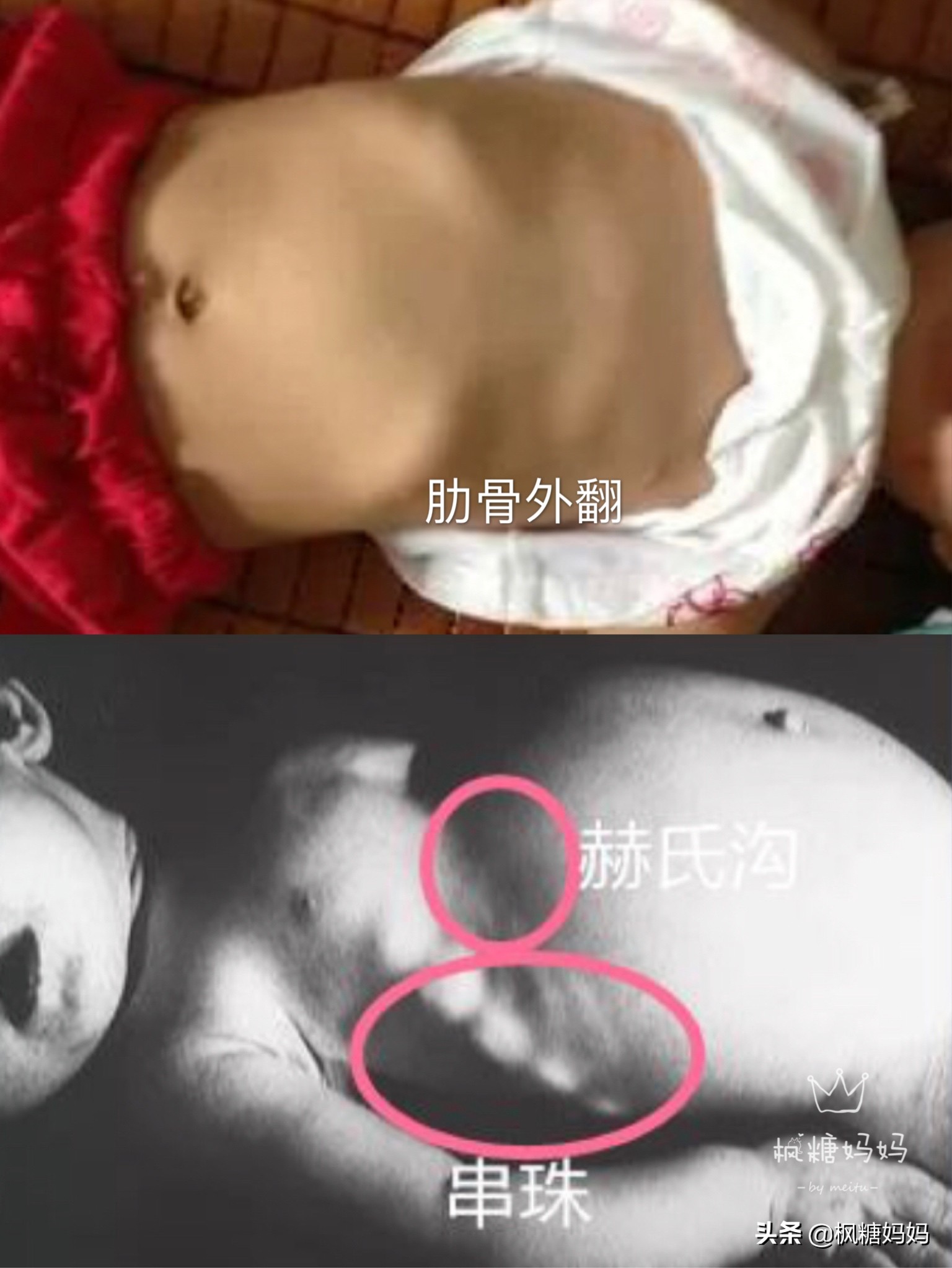 宝宝肋骨外翻是什么原因不缺钙,11岁女孩肋骨外翻是因为缺钙吗