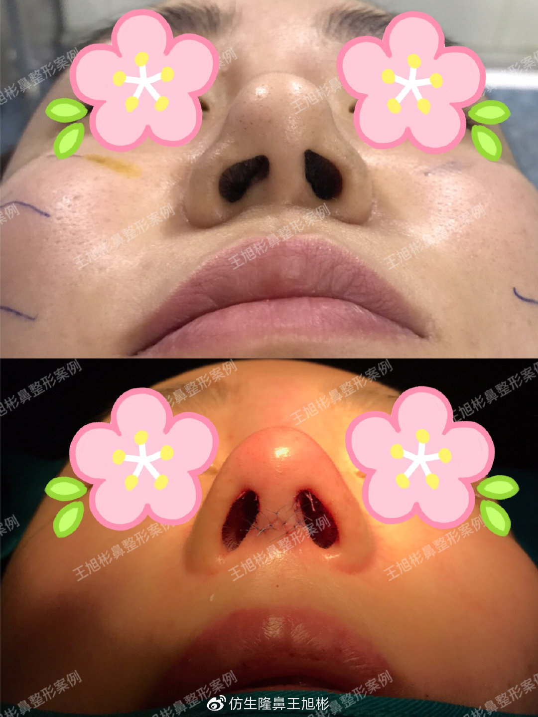 天生鼻小柱歪斜有必要修复吗,天生鼻子歪做肋骨鼻可以矫正吗