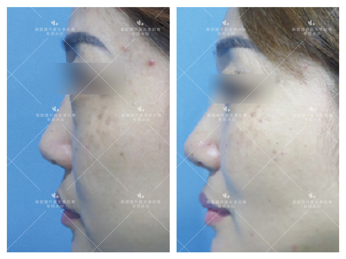 去眼袋苹果肌提升变化图,30岁面部轻微下垂眼袋泪沟