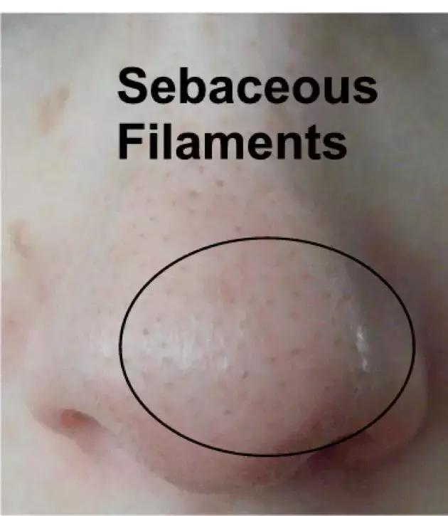 黑头为什么一直去不掉,黑头为什么总是去不掉