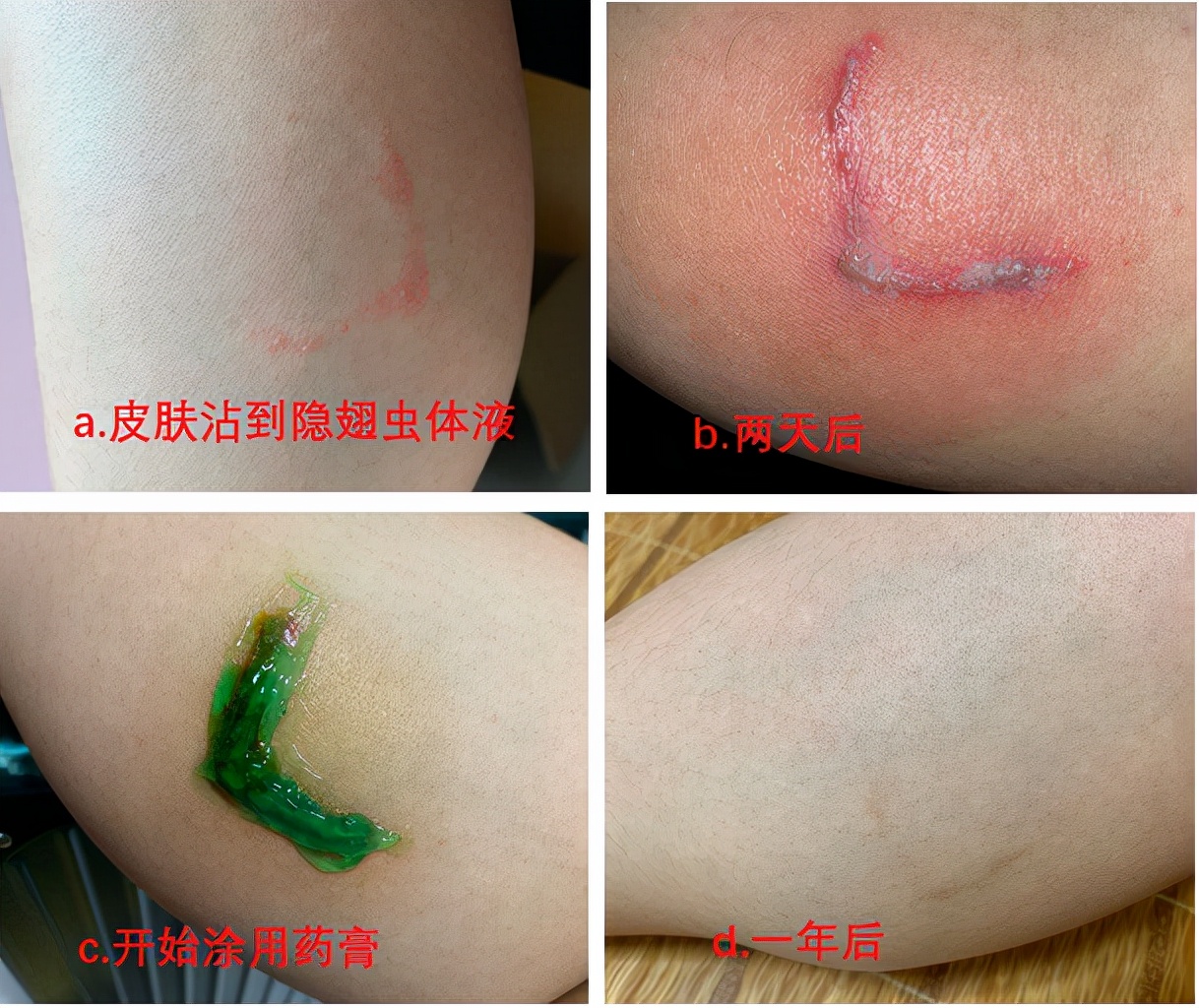 隐翅虫的毒性有多强,隐翅虫黑色的幼虫有毒吗