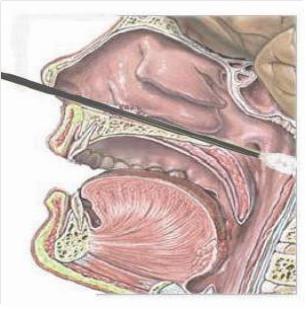 北京市新型冠状病毒核酸检测标本（鼻咽拭子）采集操作流程