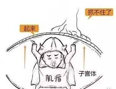 漫画详解子宫肌瘤是个啥?