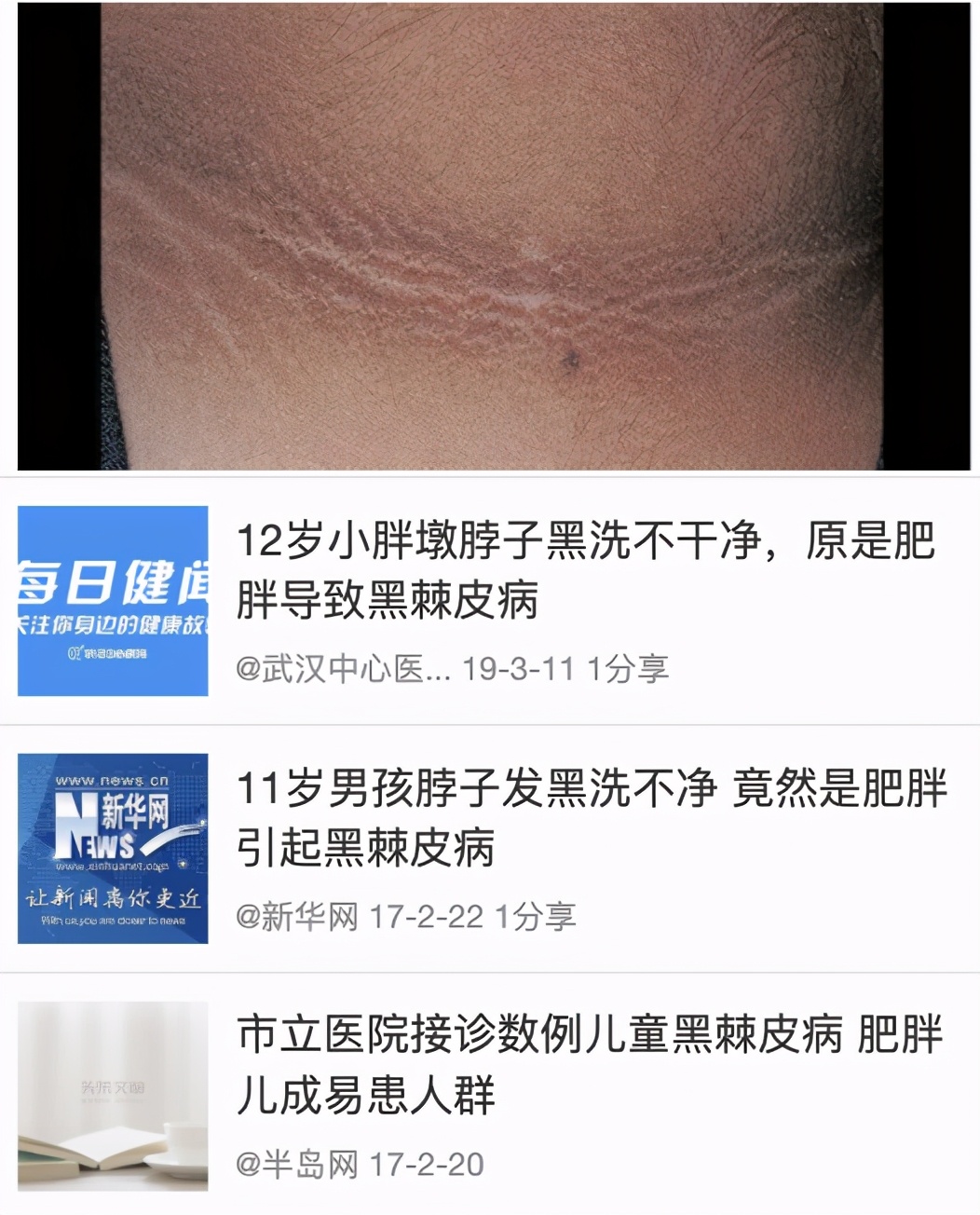 黑棘皮病皮肤发黑是对称的吗,黑棘皮症是什么原因引起的