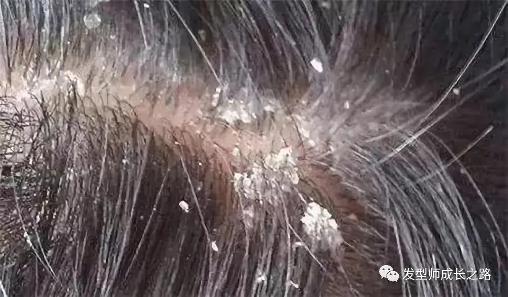 头皮屑的真正原因,头皮屑基础了解