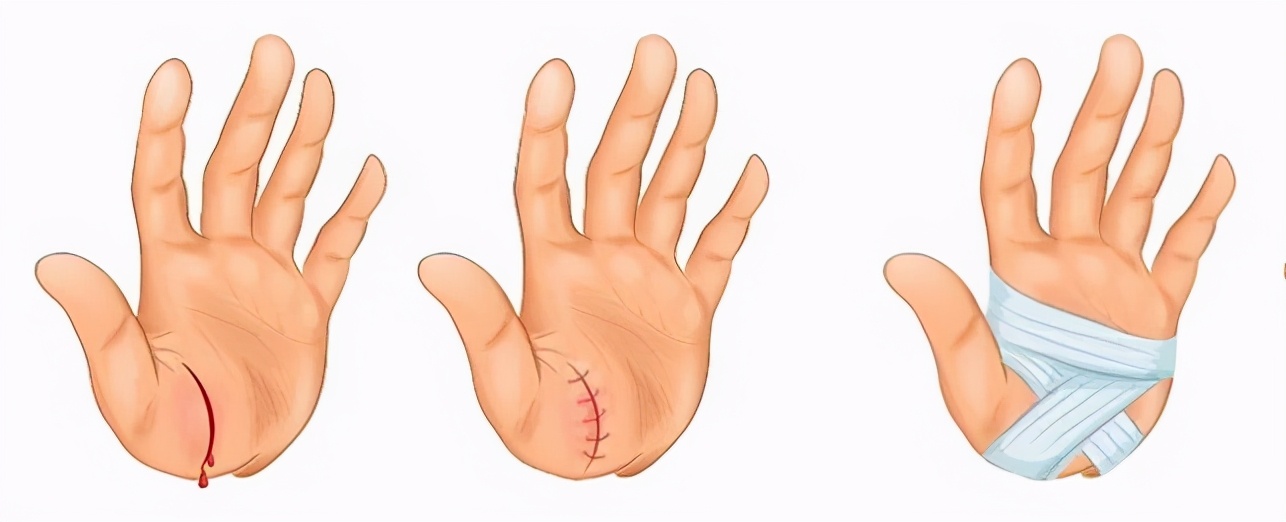 健身如何避免肌肉粘连,健身粘连是什么意思