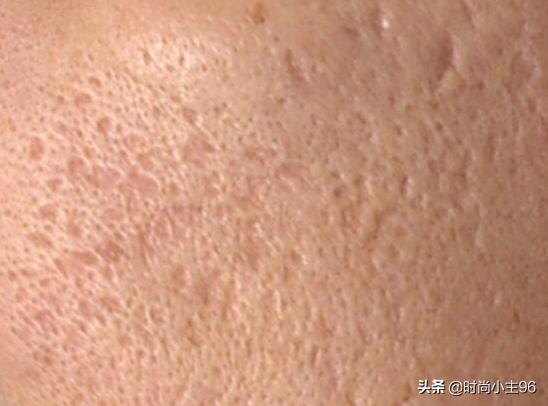 肌肤毛孔粗大出油,油性皮肤毛孔大怎么办