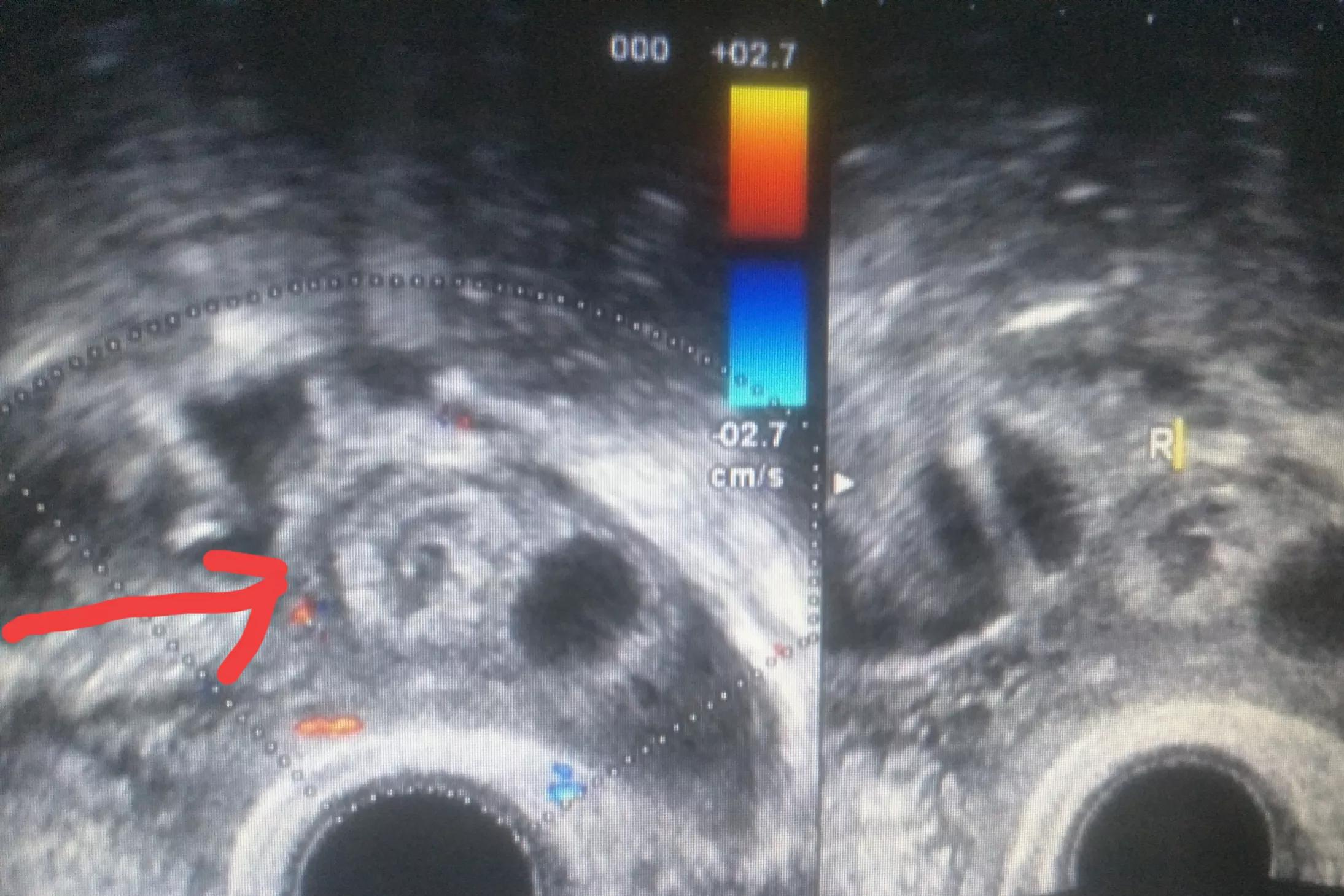 宫外孕术后怀孕几率是多少,复通术后宫外孕还能再怀孕吗