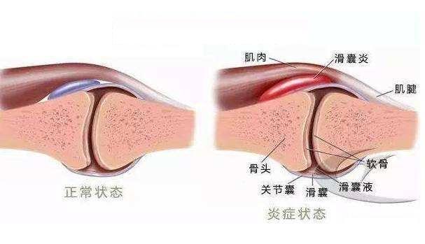 类风湿造成的关节变形可恢复吗?大多不行,有两种情况可以