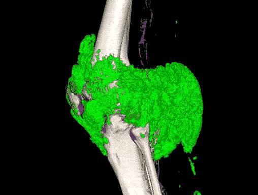 膝盖关节软骨疼痛怎么办,膝关节软骨疼痛的症状