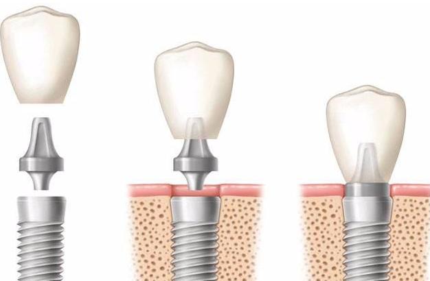 2000块的种植体你真的敢种吗?为什么会这么便宜,良心牙医告诉你
