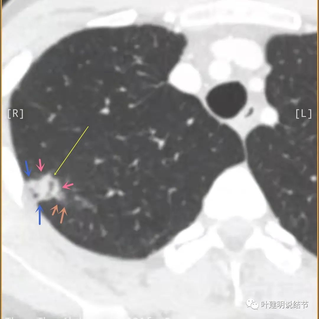 临床诊断孤立性肺结节,空洞型结节一般是什么性质