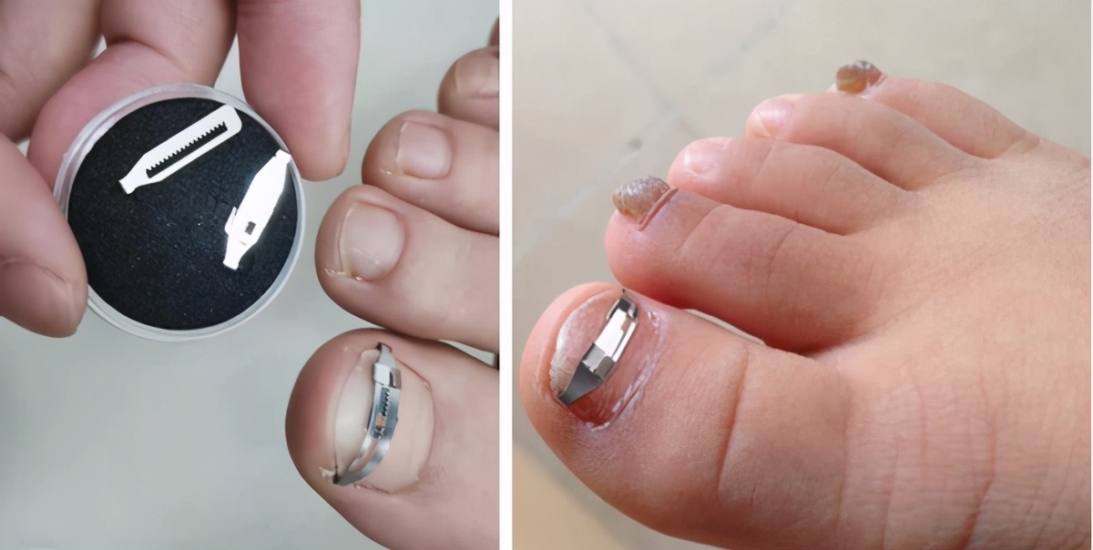 拔甲可以彻底治好嵌甲性甲沟炎吗,嵌甲甲沟炎拔了指甲还是红肿有脓