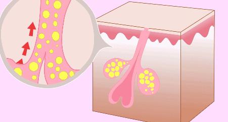 毛孔粗大怎么办什么方法有效,毛孔粗大怎么办最有效的方法