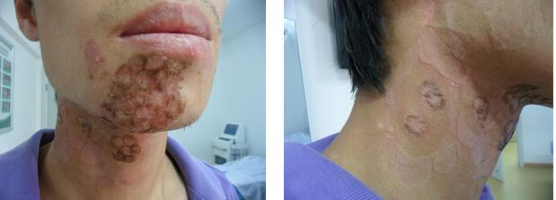 白癜风表皮移植后黑色素怎样,白癜风培植后黑色素能恢复吗