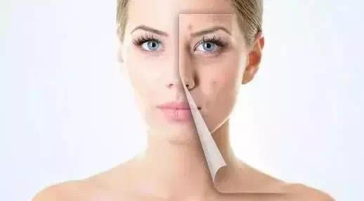 被挤发炎的闭口怎么处理,被挤了的闭口粉刺如何快速好