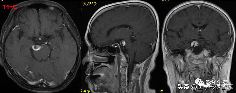 鞍区肿瘤做什么检查得出来,鞍区肿瘤的影像学鉴别