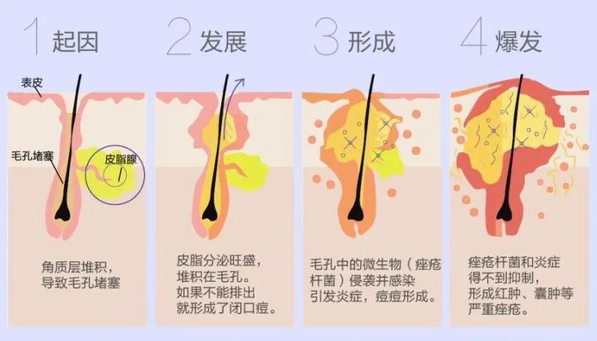 为什么你的痘印总是消不下去,为什么你的祛斑效果不理想