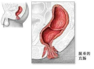 脱肛不严重怎么调理,脱肛不去医院能自愈吗