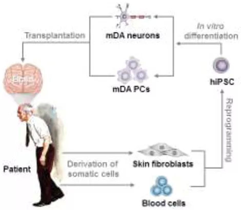 干细胞治疗帕金森最新新闻,干细胞治疗脑瘫央视报道