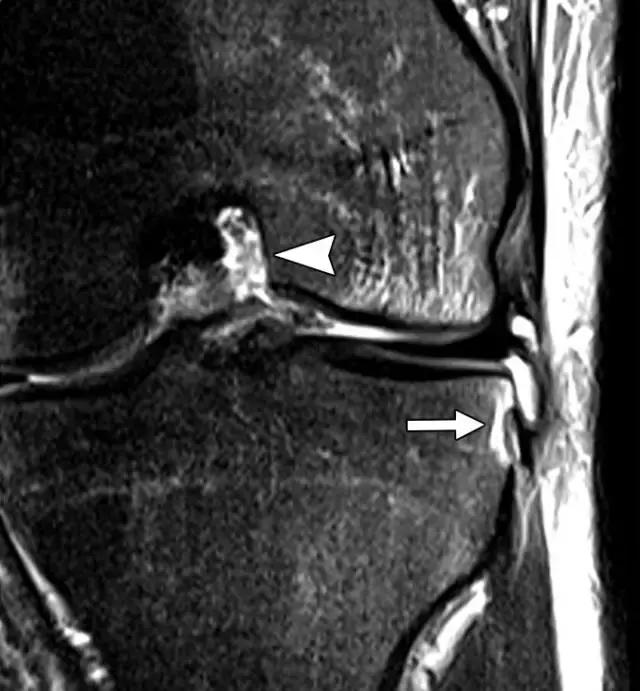 骨折处出现麻痹感,骨折跟精神状态有关