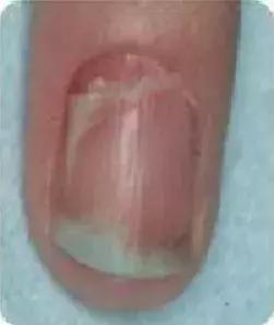 足疗店灰指甲治疗费用大概多少钱,得了灰指甲一个传染俩靠谱吗