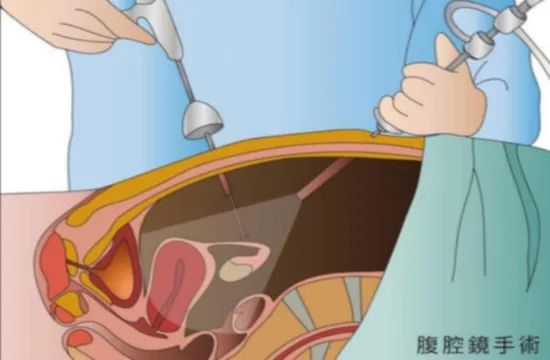 子宫肌瘤的故事12|子宫动脉阻断帮您“保留子宫，做完美女人”