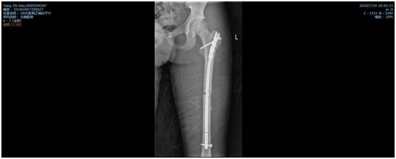 骨折一定要打石膏吗,骨折非要打钢钉吗