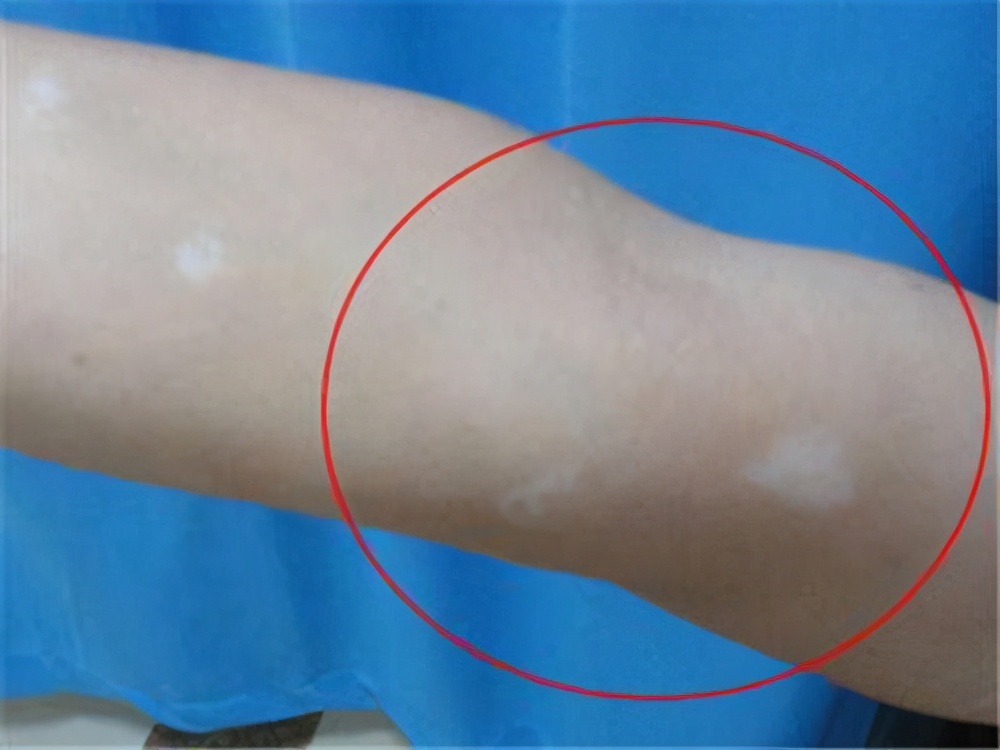 白癜风晒伤后怎样处理好,白癜风晒伤后涂什么药膏