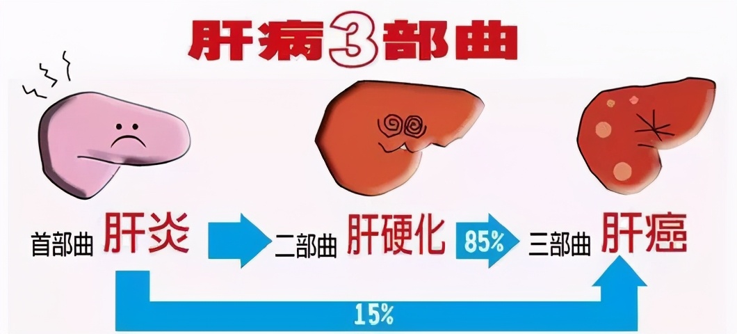 肝炎肝硬化肝癌的演变过程,乙肝肝硬化肝癌三部曲要吃什么药