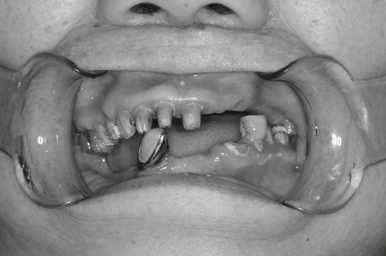 老牙崩掉一小块有事吗,吃骨头牙齿崩掉一块是什么病