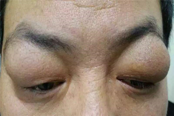 甲状腺症状有哪些明显表现,甲状腺出现问题了身体有哪些症状