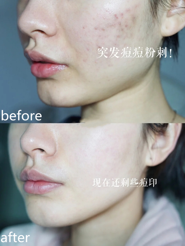 教你四个技巧拯救敏感肌,拿什么拯救敏感肌