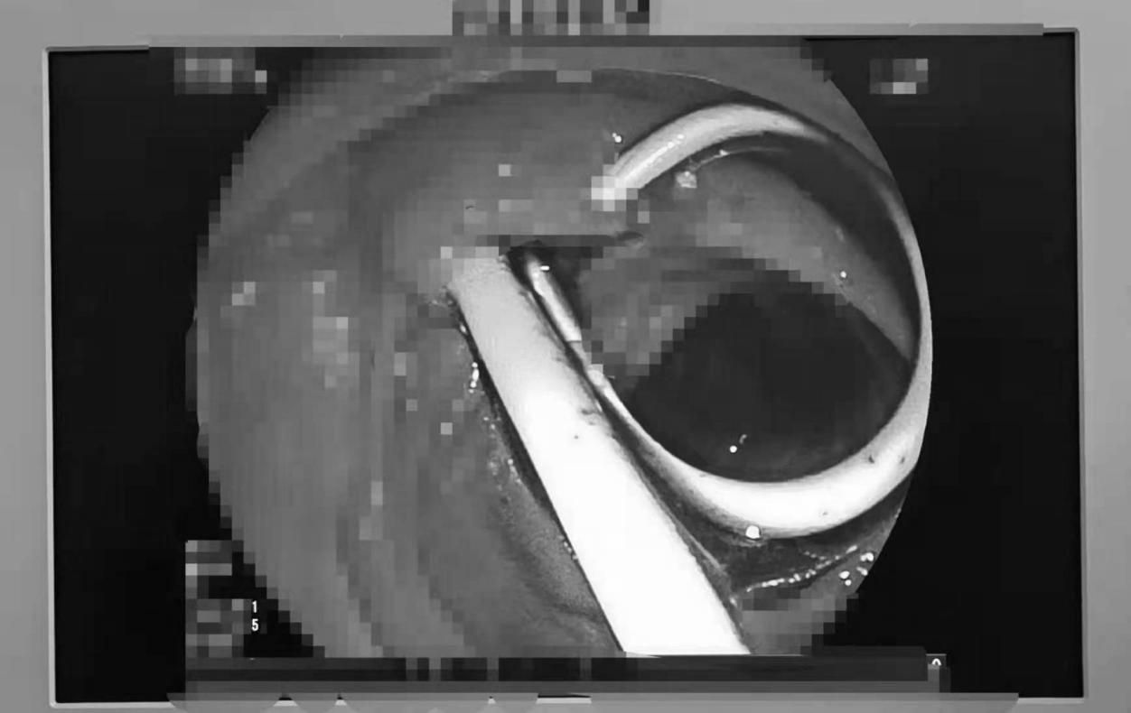 南大二附院消化内科红角洲院区胆胰团队成功完成一例经内镜下胰管巨大结石胰胆管支架联合置入术