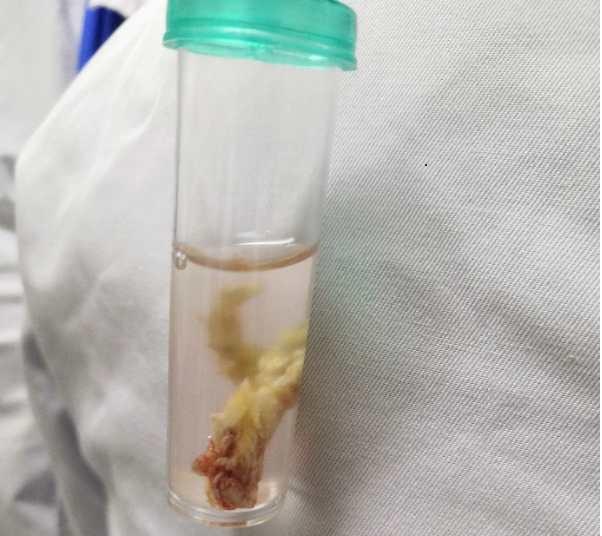 小孩支气管镜取异物技术成熟吗,小儿内镜异物取出术