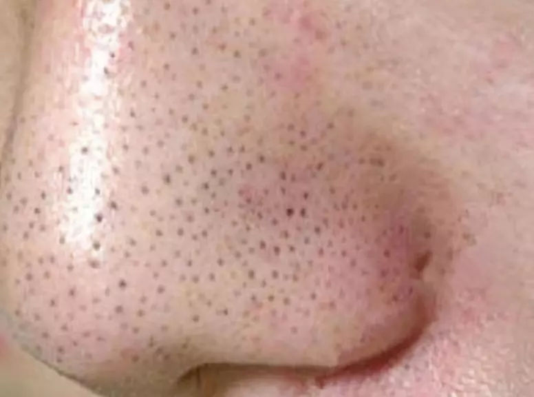 小气泡清洁推荐去黑头收缩毛孔,小气泡去黑头会让毛孔越来越大吗