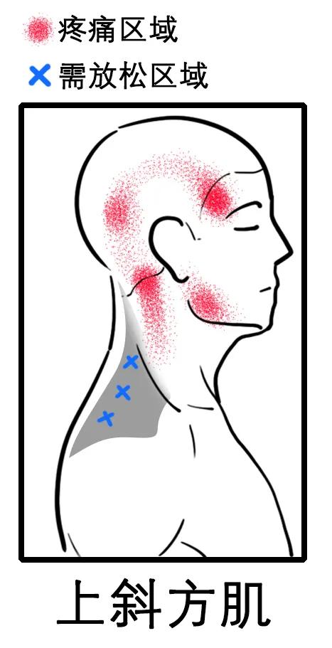 经常头痛与颈椎有关系吗如何改善,颈椎痛偏头痛按哪里