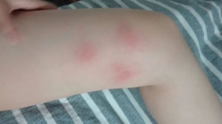 手臂起小疙瘩是荨麻疹,腿上起丘疹性荨麻疹水肿