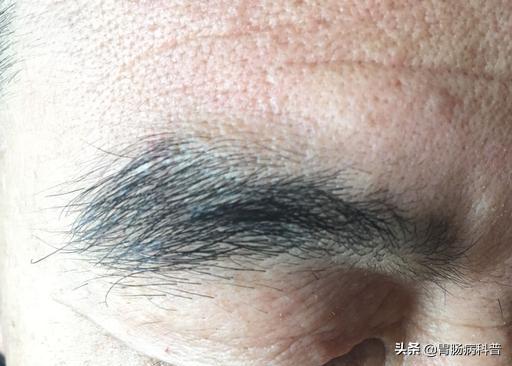 70岁老太，长出粗黑腿毛，医生说，这可能是癌的征兆